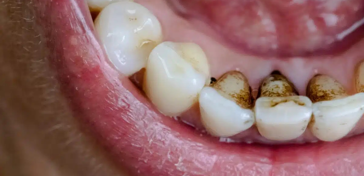 how can you remove black stains from your teeth