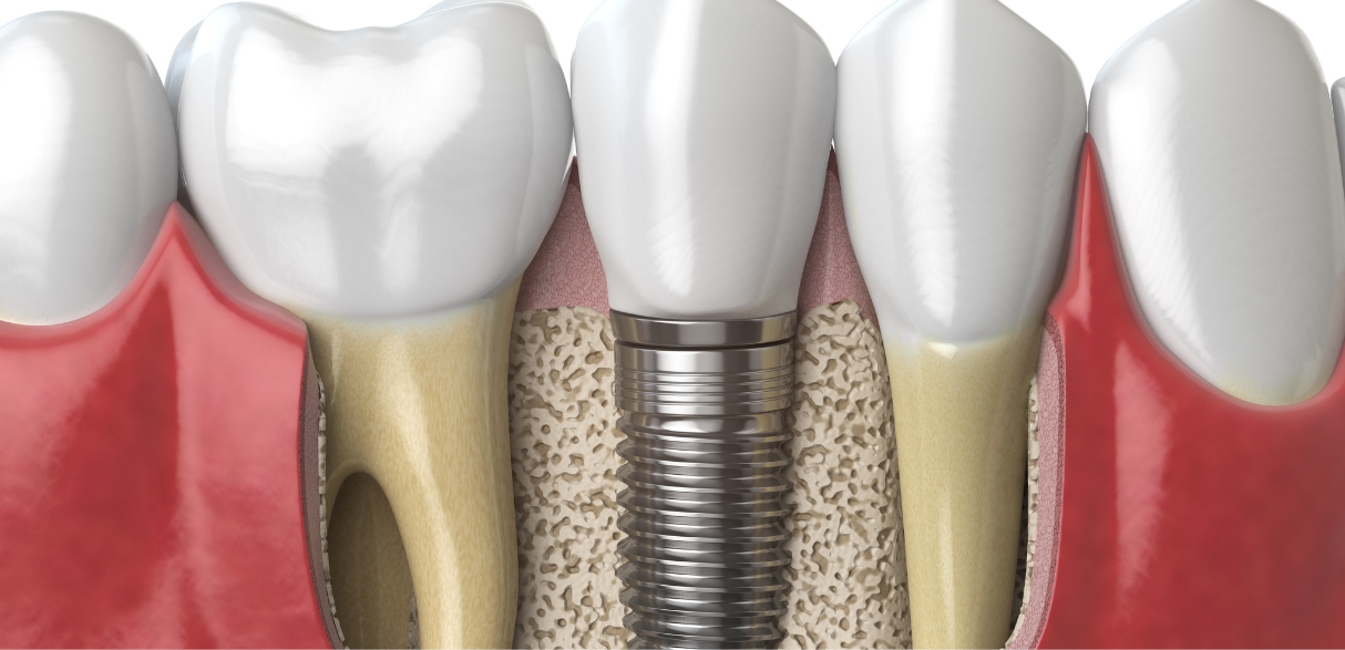 impact of dental implants on jawbone health