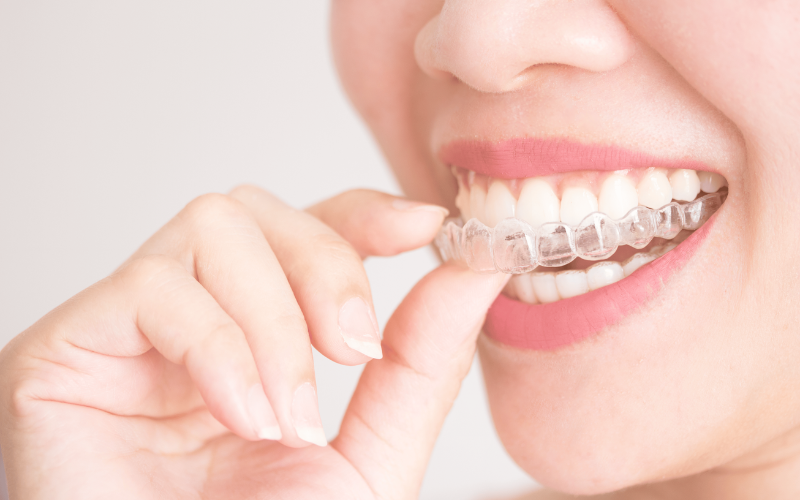 Clear Braces For Overbite