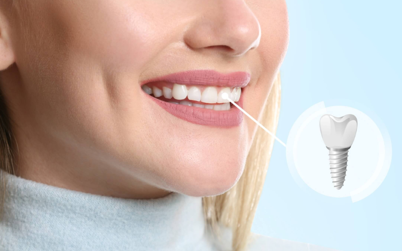 Preparing For Dental Implant Surgery