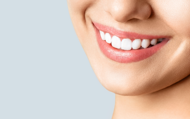 DIY Teeth Whitening or Professional Bleaching