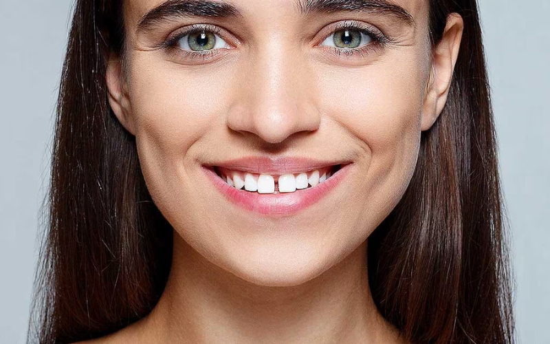 Causes and treatment of Diastema