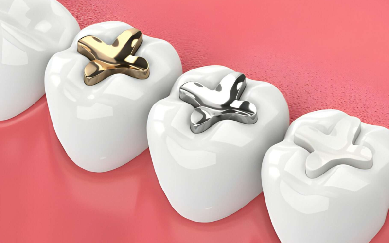 Choice Between Composite And Amalgam Fillings